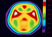 Coloured PET brain scan during listening exercise