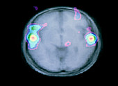 Colour PET brain scan during auditory activity