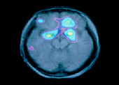 Coloured PET brain scan during olfactory activity
