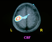 Coloured PET brain scan during tactile stimulation