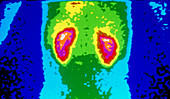 Gamma ray scan of healthy human kidneys