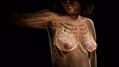 Breast Cancer Progression