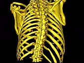 Scoliosis of the thoracic spine, rotating 3D CT scan
