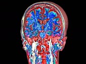 Brain and spinal cord, rotating coronal MRI scan