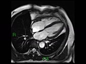 Cardiac MRI, axial dynamic scan