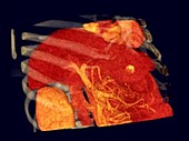 Liver cancer, rotating 3D CT scan