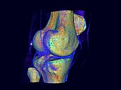Human knee, rotating 3D CT scan