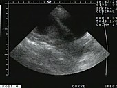 Foetus in the womb, ultrasound