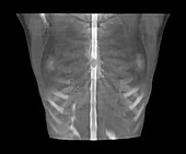 Spinal cord tumour, CT myelography scan