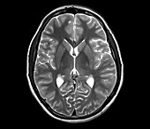 Human brain, axial MRI scan