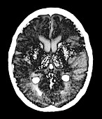 Stroke brain damage, CT scan