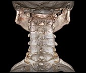 Human cervical spine, 3D CT scan
