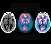 Alzheimer's disease, PET and CT brain scans