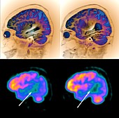 Alzheimer's disease, MRI and PET brain scans