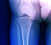 Knee osteoarthritis in obesity, X-ray