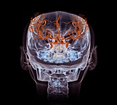 Cerebral aneurysm, 3D CT angiogram