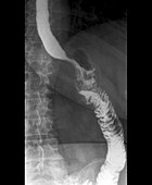 Gastric bypass, X-ray