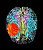 Glioblastoma brain cancer, DTI MRI scan