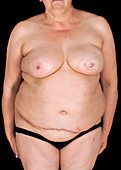 Nipple tattoo after breast reconstruction surgery