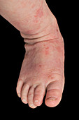 Atopic eczema on a baby's foot