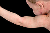 Atopic eczema on a baby's arm