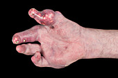 Severe gout affecting the hand