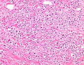 Pleomorphic lobular breast cancer, light micrograph