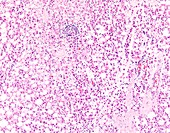 Histiocytoid lobular breast cancer, light micrograph