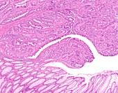 Colon cancer in a polyp, light micrograph