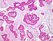 Mucinous carcinoma of the colon, light micrograph