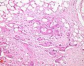 Colon cancer and fat tissue, light micrograph