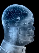 Brain tumour, composite X-ray