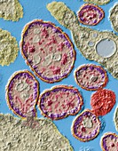 Measles virus infection, TEM