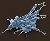 Prostate cancer cells, SEM