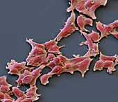 Alveolar rhabdomyosarcoma cancer cells, SEM
