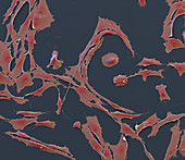 Rhabdomyosarcoma cancer cells, SEM