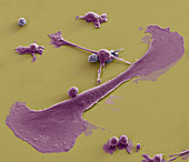 Breast cancer cells, SEM