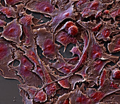 Ovarialkarzinom8 1300x - Ovarialkarzinom-Zellen aus Kultur, 1300-1