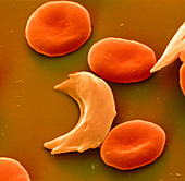 Coloured SEM of blood in sickle cell anaemia