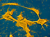 Coloured SEM of neuroblastoma cancer cells