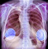 Breast implants, X-ray