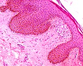 Heavily pigmented skin, light micrograph
