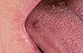 Haemangioma on the tongue