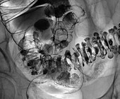 Diverticulosis in large intestine, X-ray