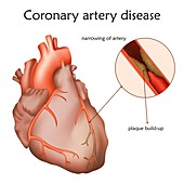 Coronary artery disease, illustration