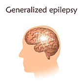 Generalized epilepsy, illustration