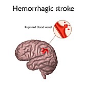 Haemorrhagic stroke, illustration