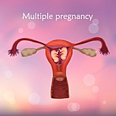 Multiple pregnancy, illustration