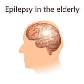 Epilepsy in the elderly, illustration