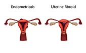 Endometriosis and uterine fibroid, illustration